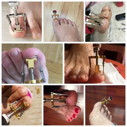 Ingrown Toenails correction pedicure foot  toe nail care tools file Elastic Patch Straightening Clip Brace corrector Wire Fixer