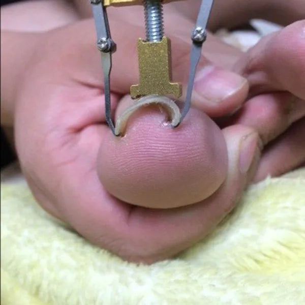 Ingrown Toenails correction pedicure foot  toe nail care tools file Elastic Patch Straightening Clip Brace corrector Wire Fixer